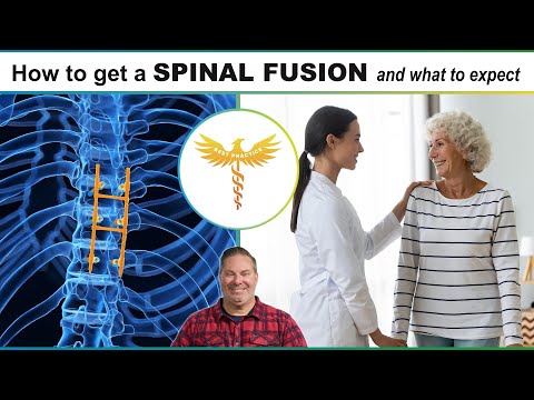 Spine surgeon explains: What to Expect with spine fusion, back pain, spondylolisthesis with stenosis