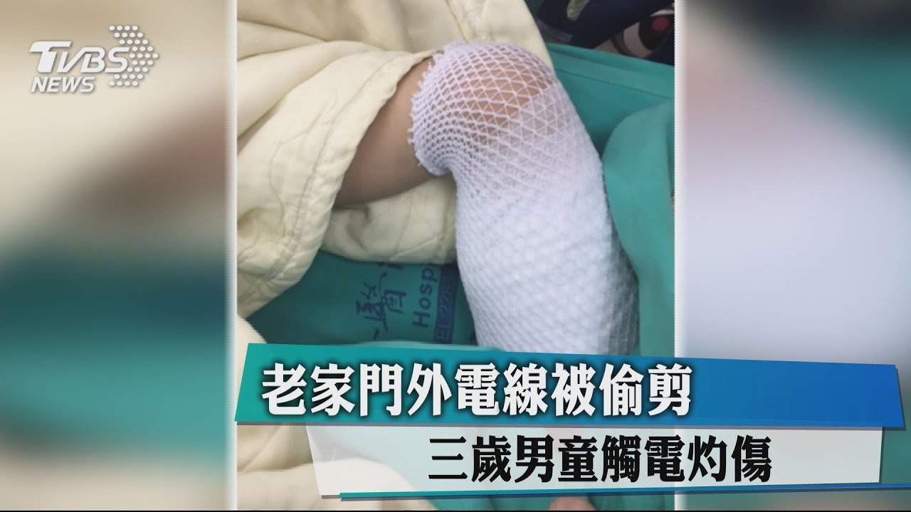 老家門外電線被偷剪 3歲男童觸電灼傷