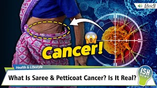 What Is Saree and Petticoat Cancer? Is It Real?