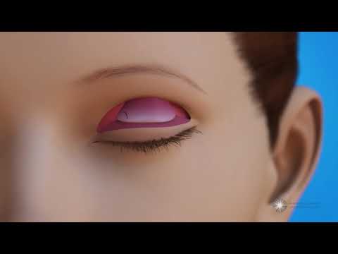 Levator Resection for Ptosis Repair Surgery (Eyelid Lift)