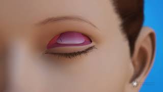 Levator Resection for Ptosis Repair Surgery (Eyelid Lift)