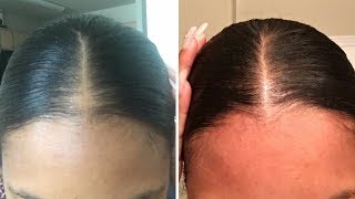How I Gave Myself a Bald Spot and Grew it Back