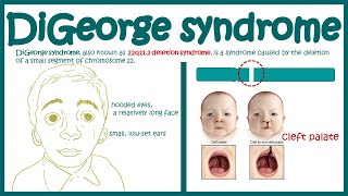 DiGeorge syndrome || 22q11. 2 deletion syndrome || Immunodeficiency