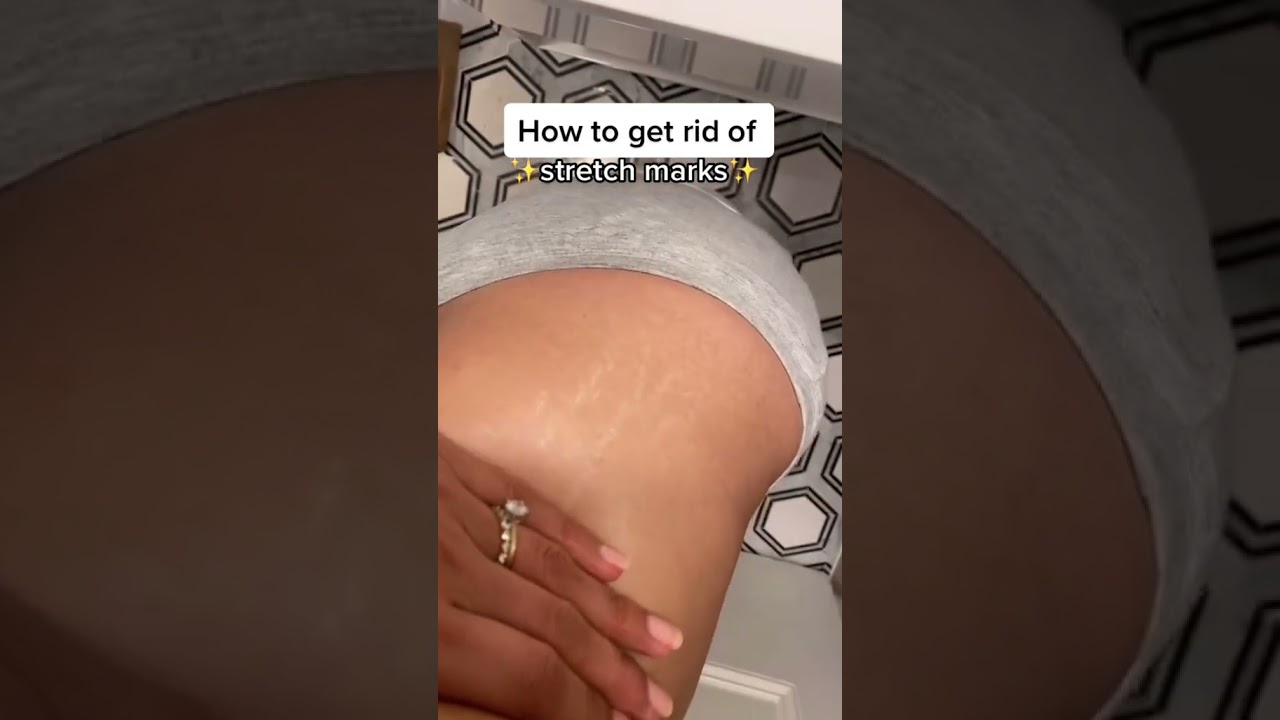 How To Get Rid Of Stretch Marks #beautyhacks #skincarehacks #lifehacks
