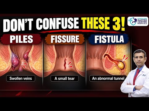 Blood in Stool? Pain While Passing Motion? Know If It's Piles, Fissure or Fistula | Doctor Explains
