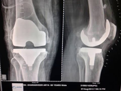 Dr Anurag Awasthi l Orthopedic Surgeon l Knee Replacement l Gurgaon- Ph 8447918981