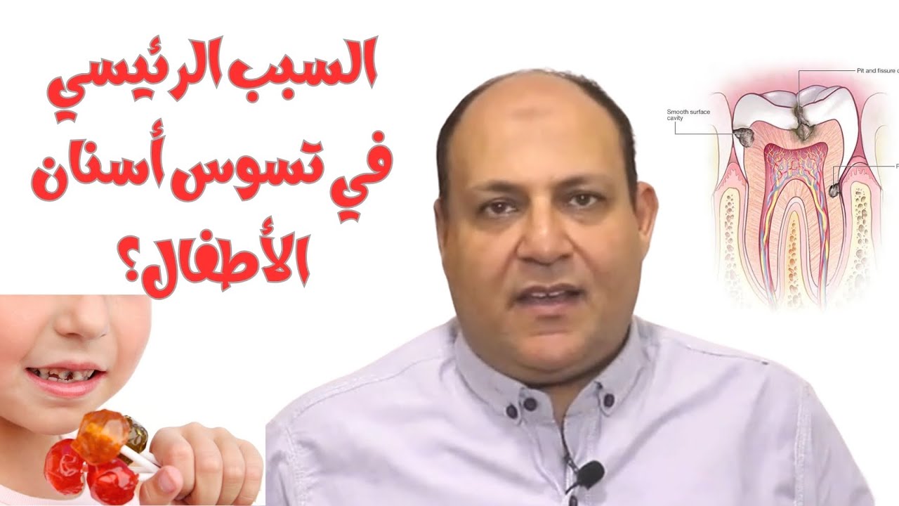 السبب الرئيسي في تسوس أسنان الأطفال