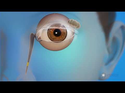 Probing to Open Blocked Tear Ducts