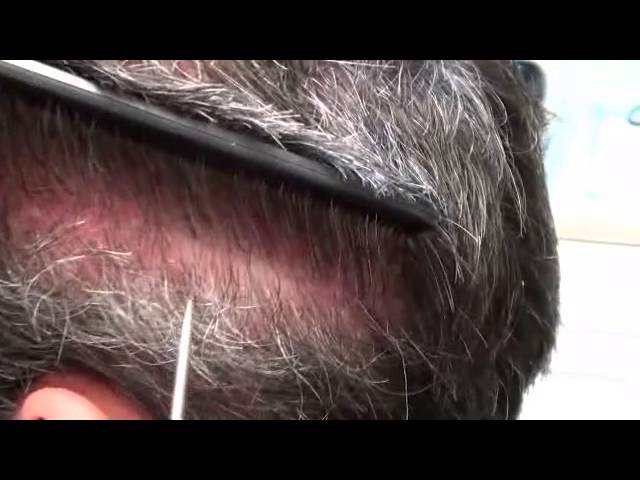 Patient 301's 4mo Scar