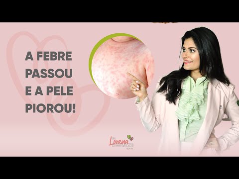 Criança com roséola: e agora?