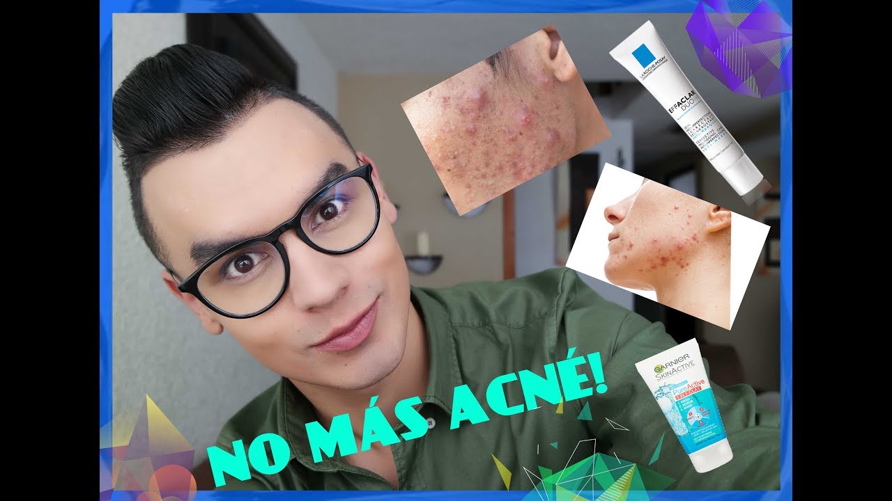 ¿Cómo Eliminar El Acné 😊 La Roche Posay Effaclar Duo + Review Con y Sin SPF 30 😍