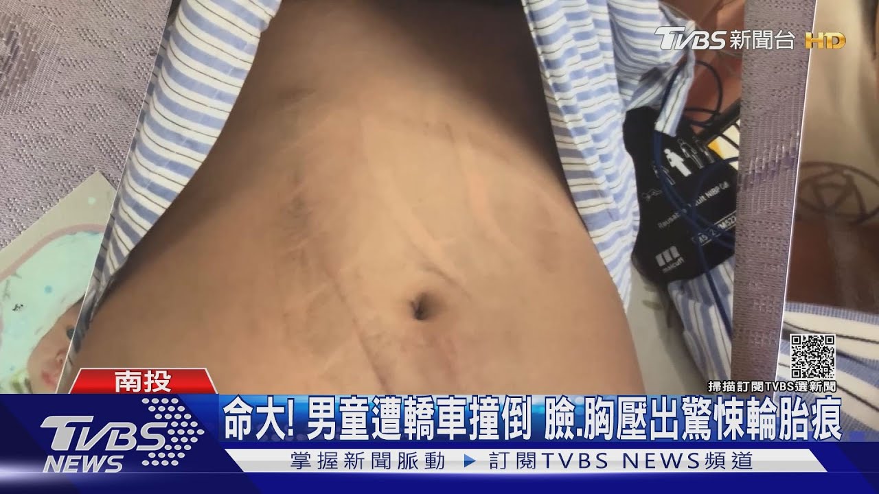 小五童被車輾!壓出「輪胎痕」瘀傷 控對方不理