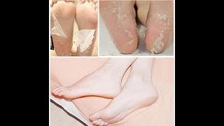 REMOVE DEAD SKIN FROM FOOT | FOOT MASK PEELING CUTICLES | FEET CARE ANTI AGING - For 9$