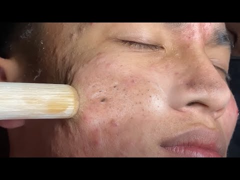 Make your Acne Treatment Huong Da Nang Part 2 | 433 # acne 2022