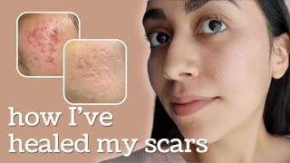 Healing Hyperpigmentation + Deep Pitted Acne Scars (this is what I’ve done)
