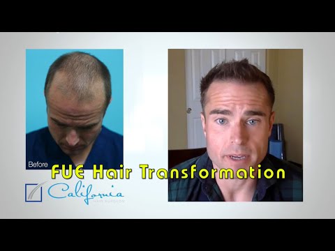 FUE Hair Transplant Testimonial