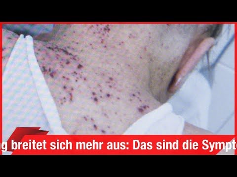 Schulterbandage auf dem Schultergelenk CT der Halswirbelsäule mit dem Wiederaufbau