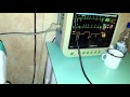 Pacemaker magnet test. Магнитный тест - проверка ...