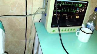 Pacemaker  magnet test. Магнитный тест - проверка кардиостимулятора.