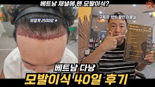 다낭 사는 아저씨가 모발이식하고 난 40일 후기 + 다낭 미용실 구독자 10% 할인 (베트남다낭)