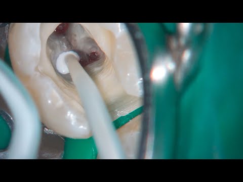 Domenico Ricucci.  Full (pulp chamber) pulpotomy in a mandibular second molar