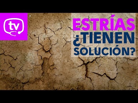 ¿Las estrías tienen solución?