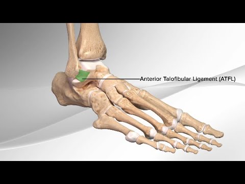 Chronic Ankle Sprain Repair With the InternalBrace™ Ligament Augmentation Procedure