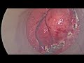 TAMIS excision of Rectal GIST following effective treatment with neoadjuvant Imatinib
