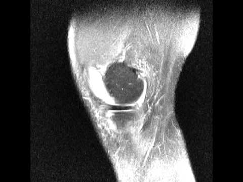 Entzündung der Gelenke bei Arthrose reduzieren Video wie Chirurgie für Kniegelenkersatz tun