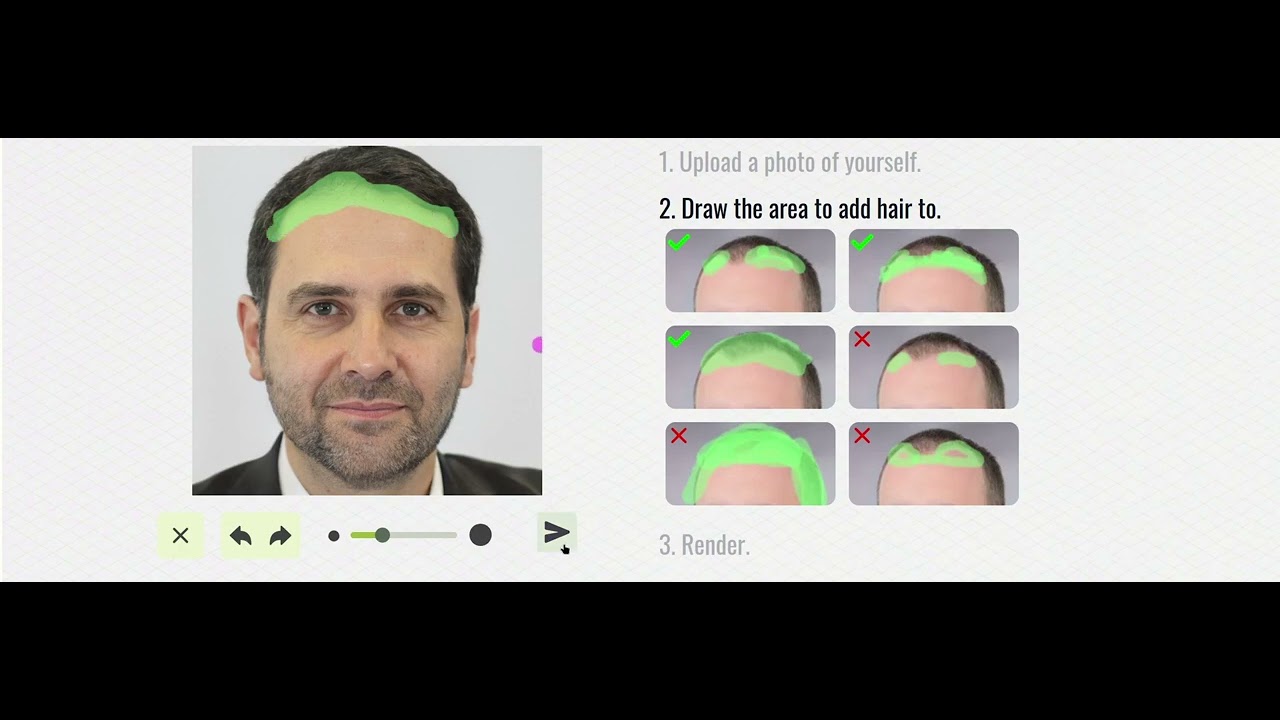 Hair Transplant Simulation Web Widget