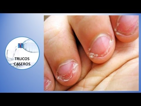 Consejos caseros para no morderse las uñas