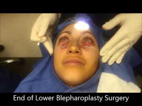 Lower Blepharoplasty to Reduce Dark Circles & Remove Eyelid Bags – Izabelle Patient Testimonial Lower Blepharoplasty to Reduce Dark Circles & Remove Eyelid Bags – Izabelle Patient Testimonial
