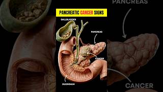 Pancreatic Cancer Warning Signs You Shouldn’t Ignore 🚨