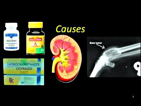 Hypercalcemia of Malignancy - Medical Presentation