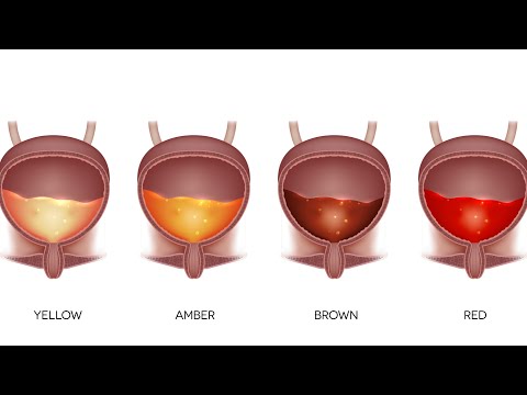 infecție giardia scaun galben)