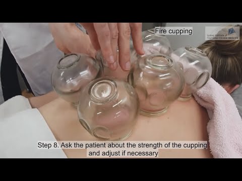 Cupping