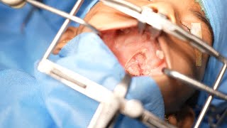 Emergency Surgery | Small Boy | Hit by a Stick in Soft palate