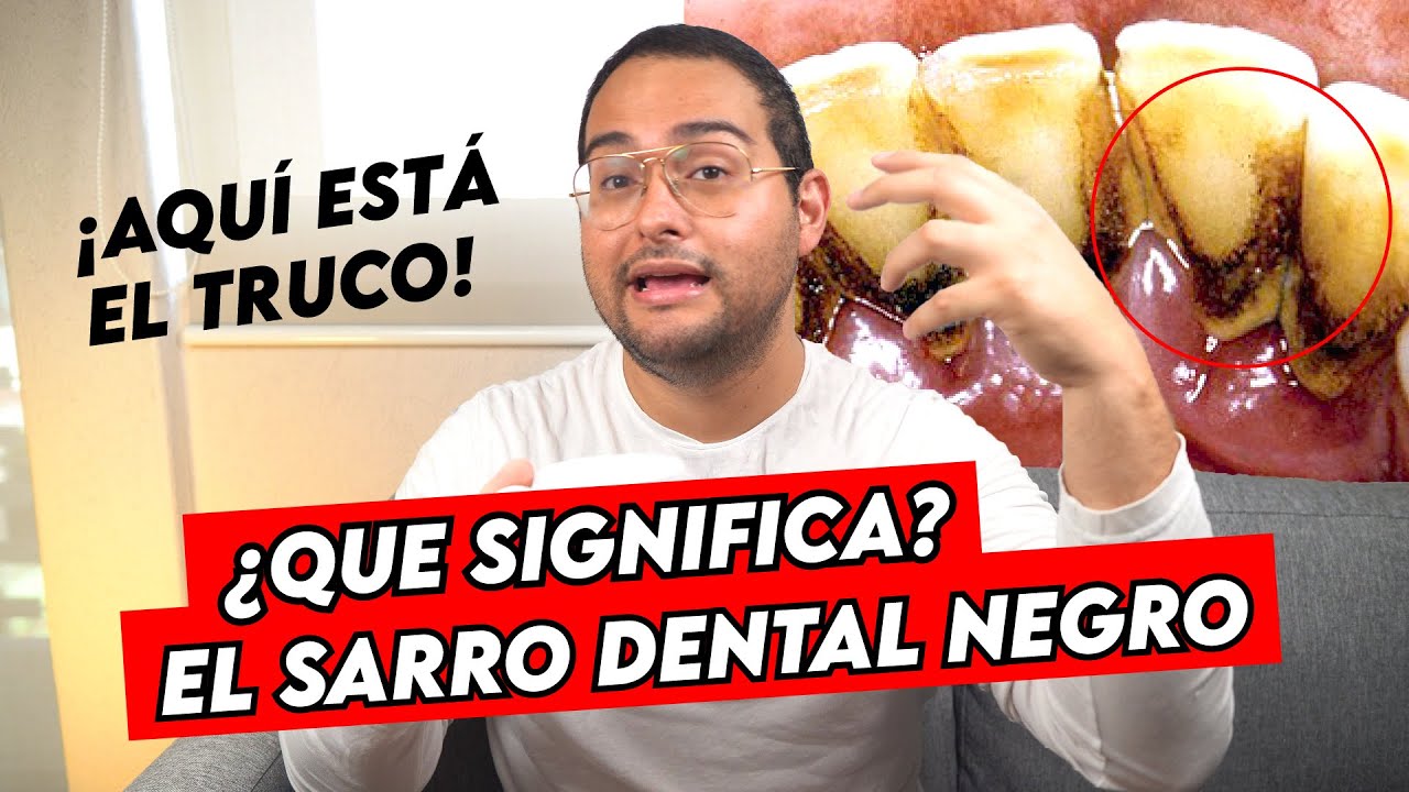 ¡EL SARRO DENTAL NEGRO! ¿QUE SIGNIFICA EL COLOR DEL CALCULO DENTAL Y COMO QUITARLO DE LOS DIENTES
