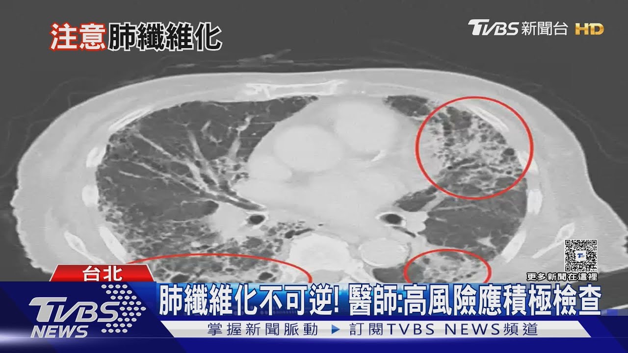 長期咳嗽+運動就喘 勿輕忽!恐罹「菜瓜布肺」致死風險高!