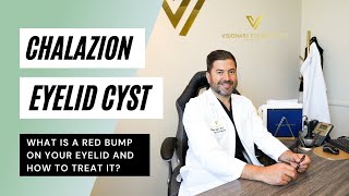 CHALAZION - WHAT IS A RED BUMP ON YOUR EYELID AND HOW TO TREAT IT