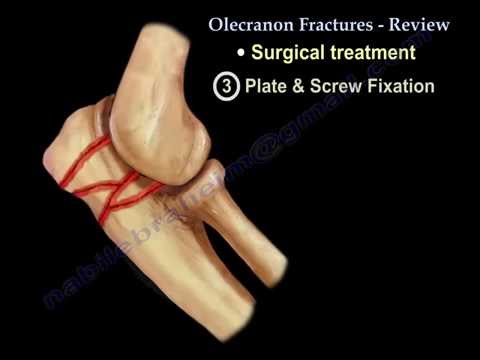 Fractures de l'olécrâne