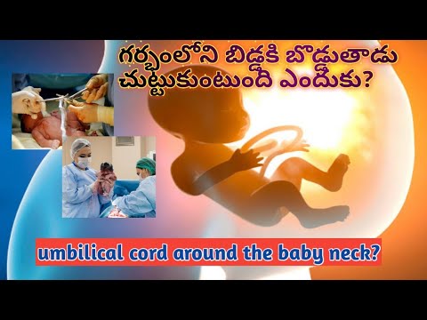 గర్భంలోని బిడ్డ గొంతుకి బొడ్డుతాడు చుట్టుకుంటుంది ఎందుకు? umbilical acord around the baby neck?