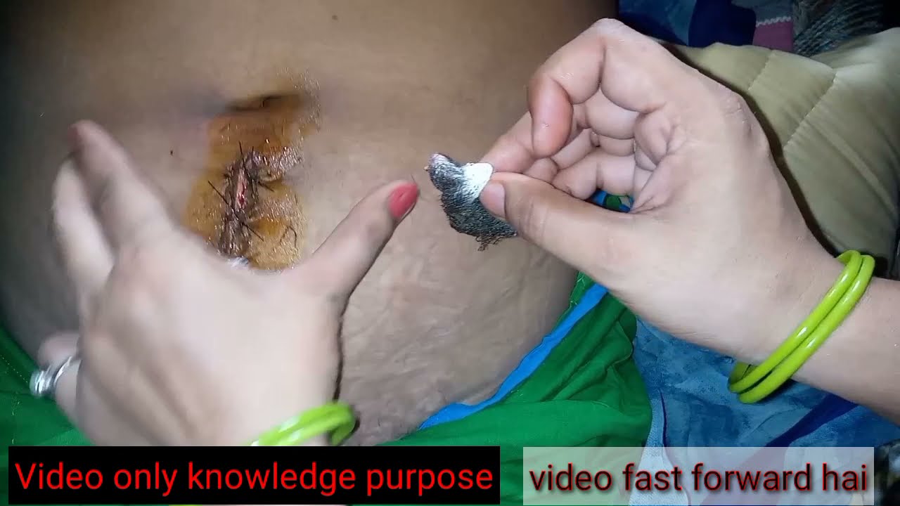 #cesarean #stitches #cesareandelivery || टांको की सफाई और उनकी देखभाल ||