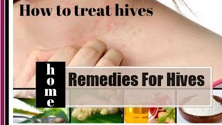 How to treat hives | home remedy for hives
