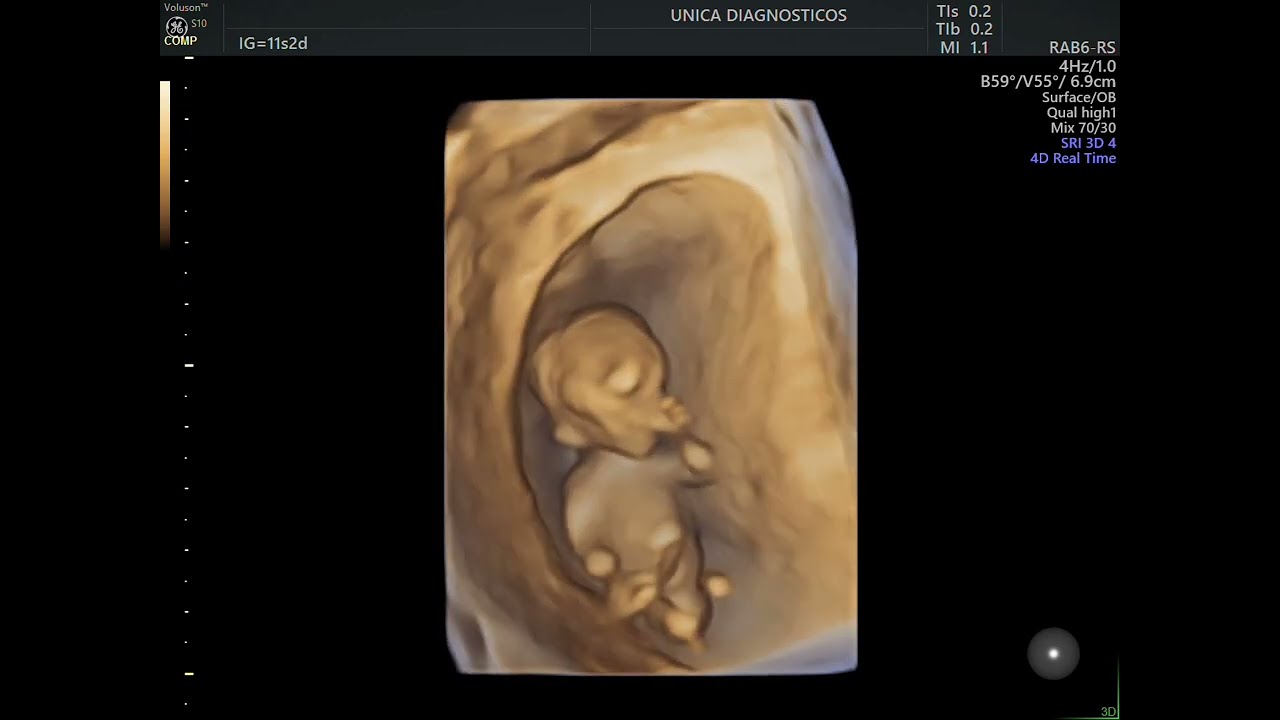 Ultrassom 4D em gestação de 12 semanas - 3