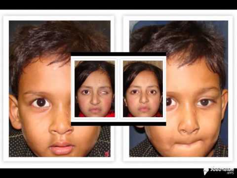 artificialeye.co.in - artificial eye india,artificial eye in punjab, Eye prosthesis in india