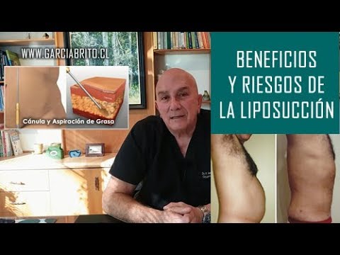 Beneficios y Riesgos de la Liposucción