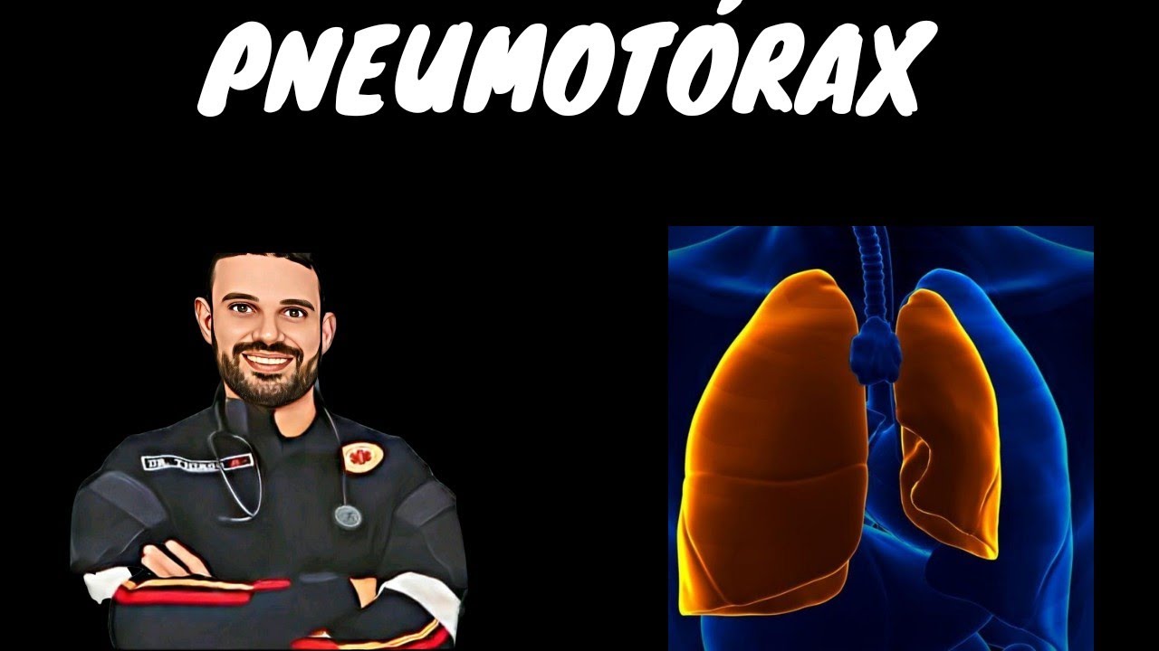 PNEUMOTÓRAX NO TRAUMA