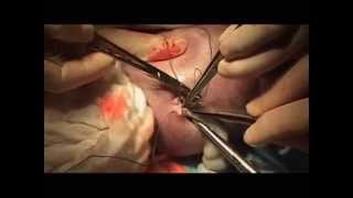 preview picture of video 'Gastrosquisis, Exit tratamiento quirúrgico, Reducción completa con soporte placentario'