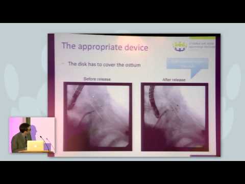 Ensuring implant success: a step-by-step approach for LAA Occlusion